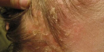Атопический дерматит на голове: симптомы и лечение